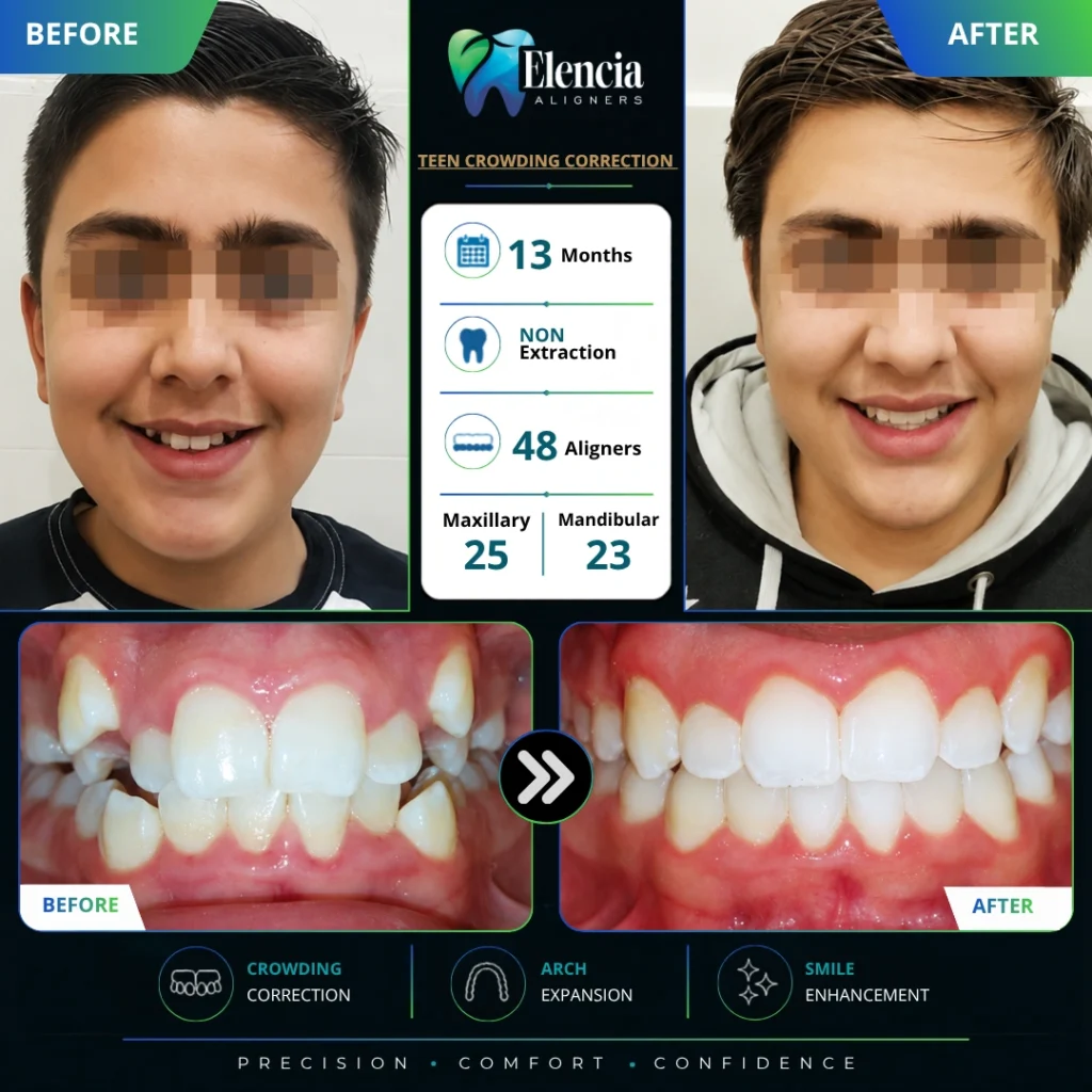 Before and after of teen crowding correction with 48 Elencia clear aligners over 13 months