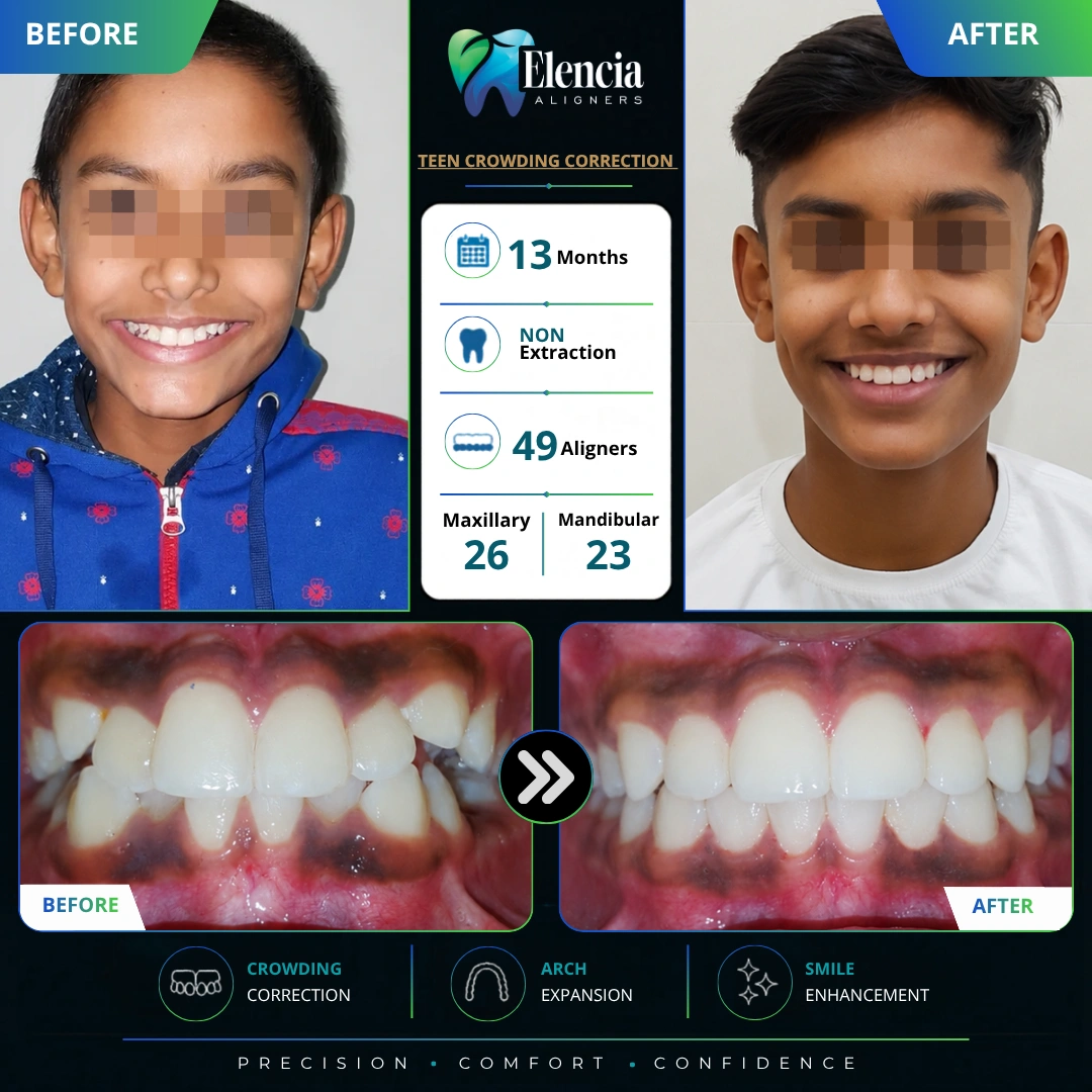 Before and after of teen crowding correction with 49 Elencia clear aligners over 13 months using a non-extraction approach.