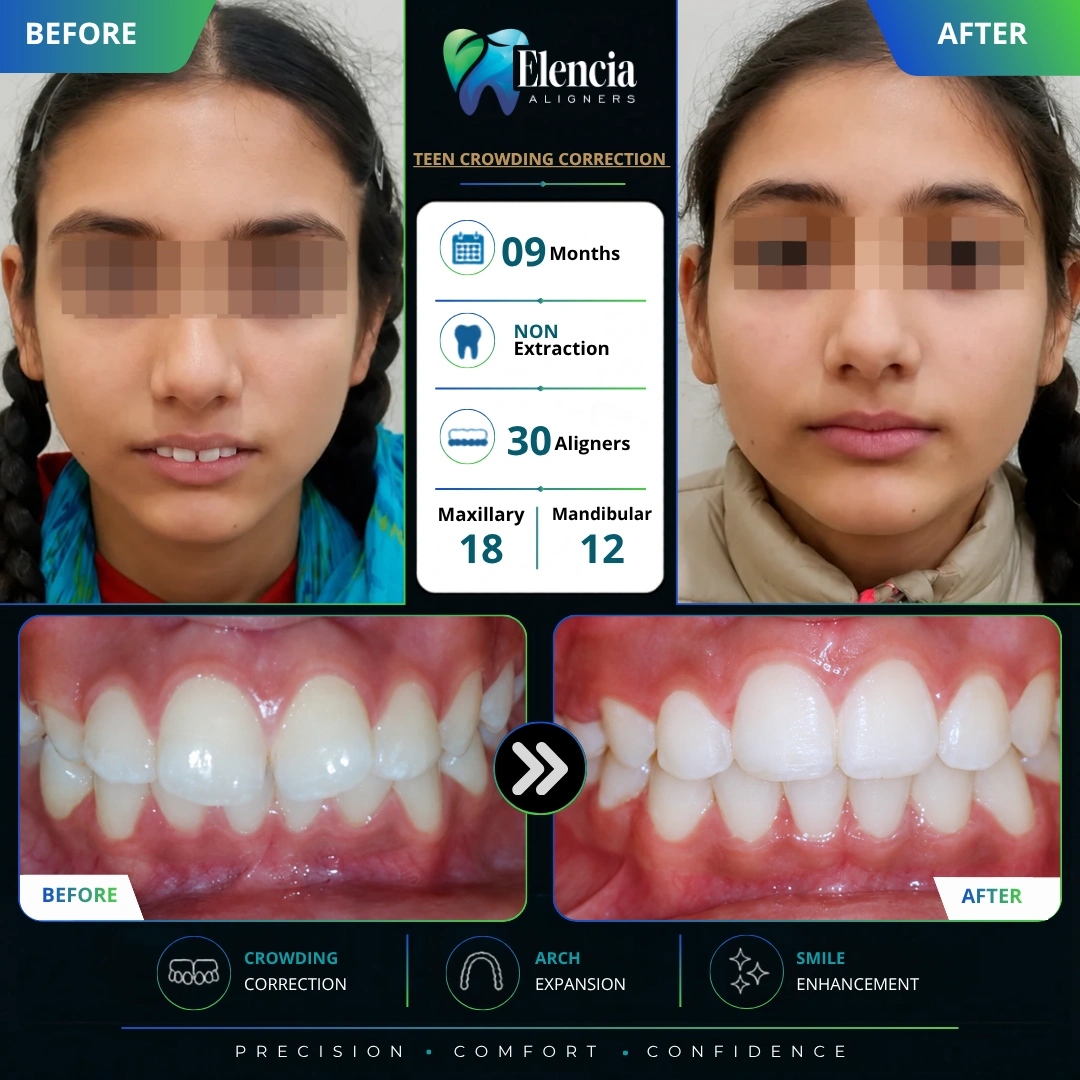 Before and after of teen crowding correction with 30 Elencia clear aligners over 9 months using a non-extraction approach.