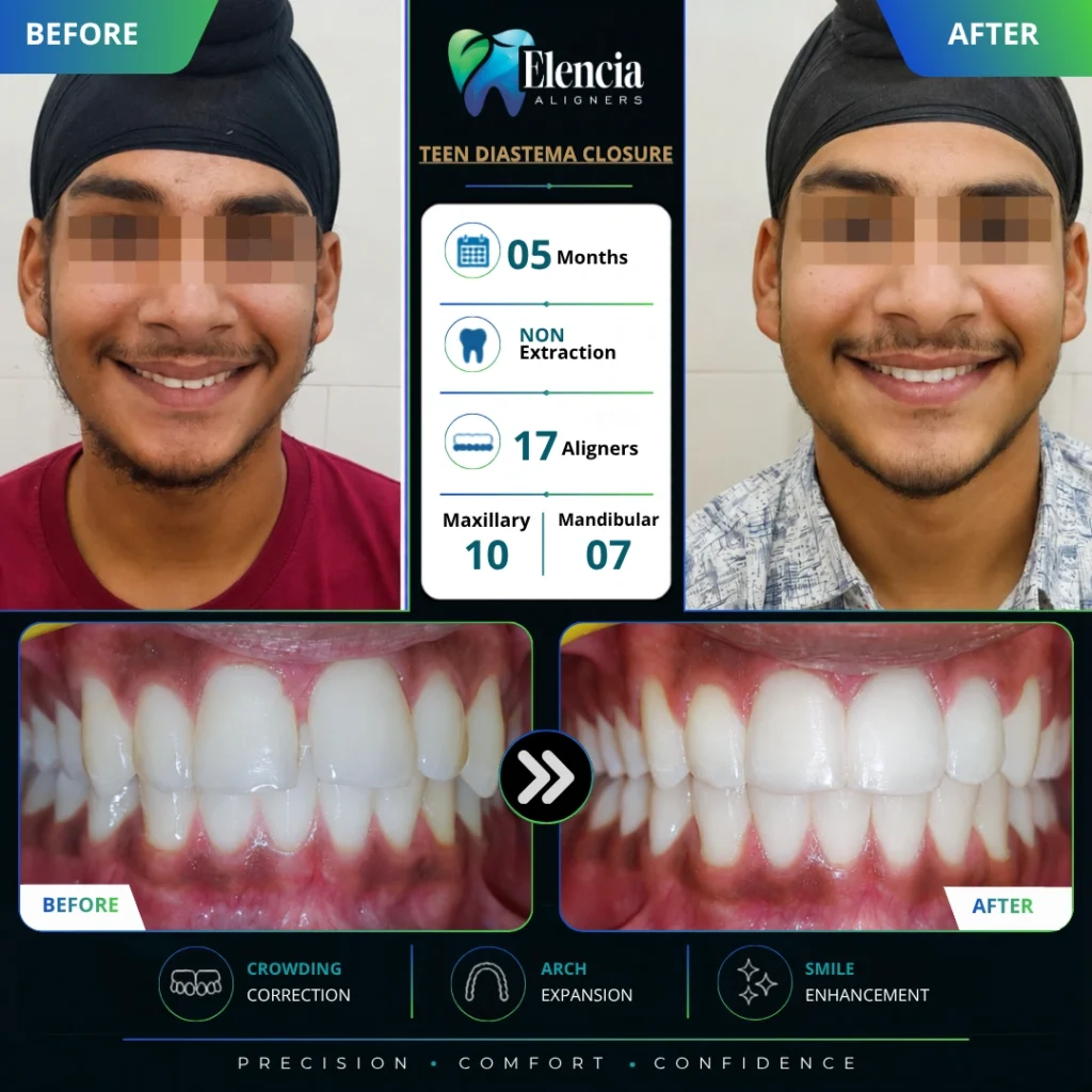 Before and after of teen diastema closure with 17 Elencia clear aligners over 5 months using a non-extraction approach.