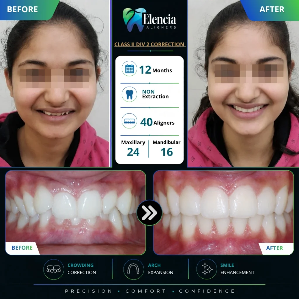 Class II Div Correction 12 Months 40 Aligners