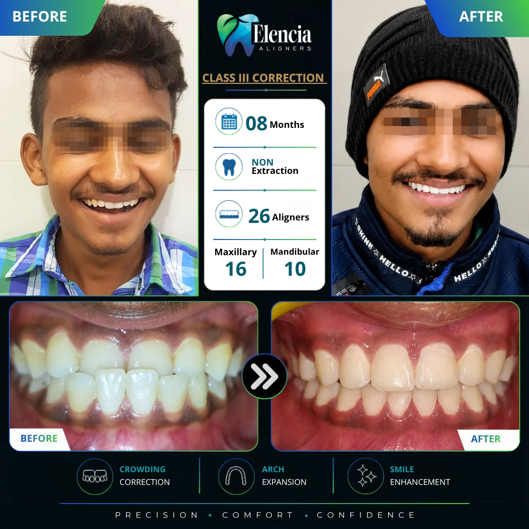 Class-III-08-months-26-Aligners