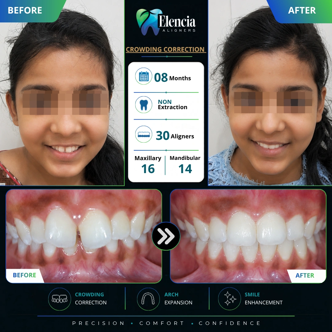 Crowding-Correction-08-months-30-Aligners