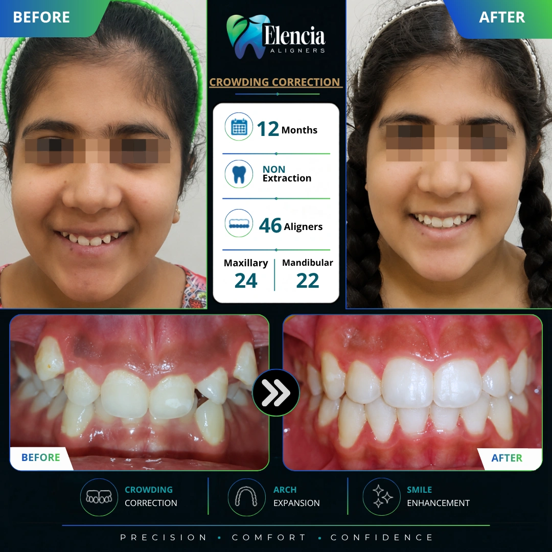 Crowding-Correction-12-Months-46-aligners