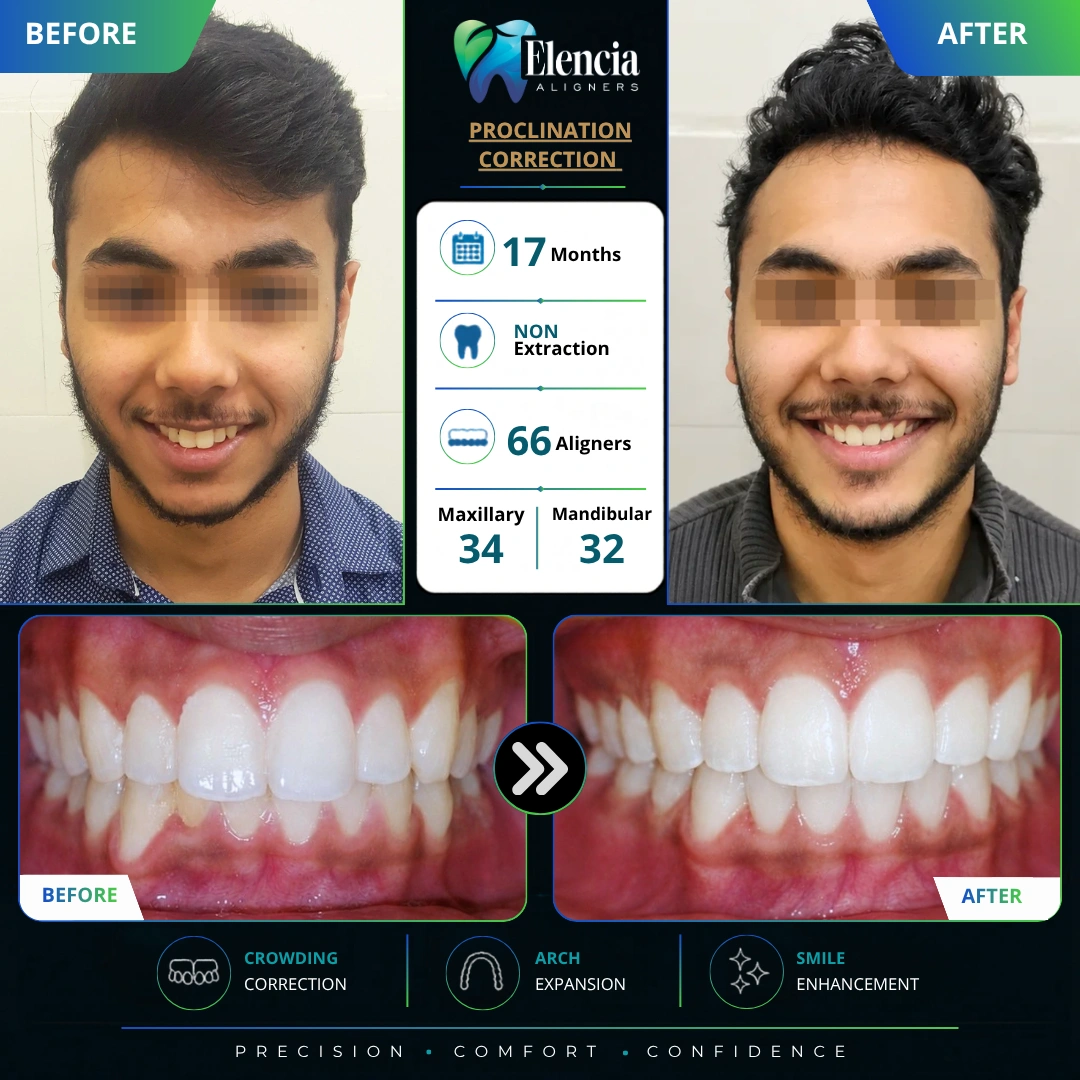 Proclination-Correction-17-months