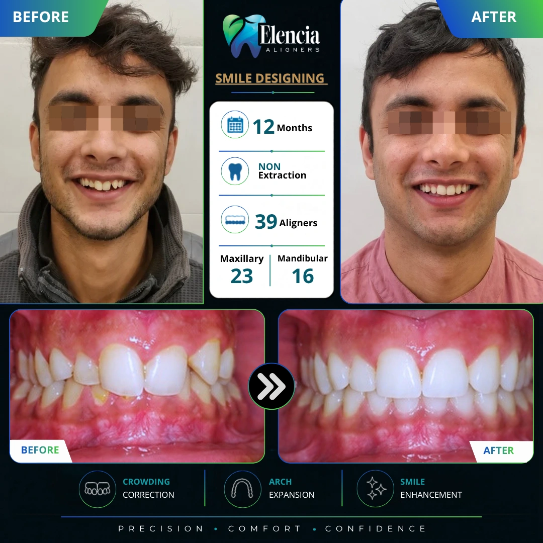 Smile-Designing-12-Months