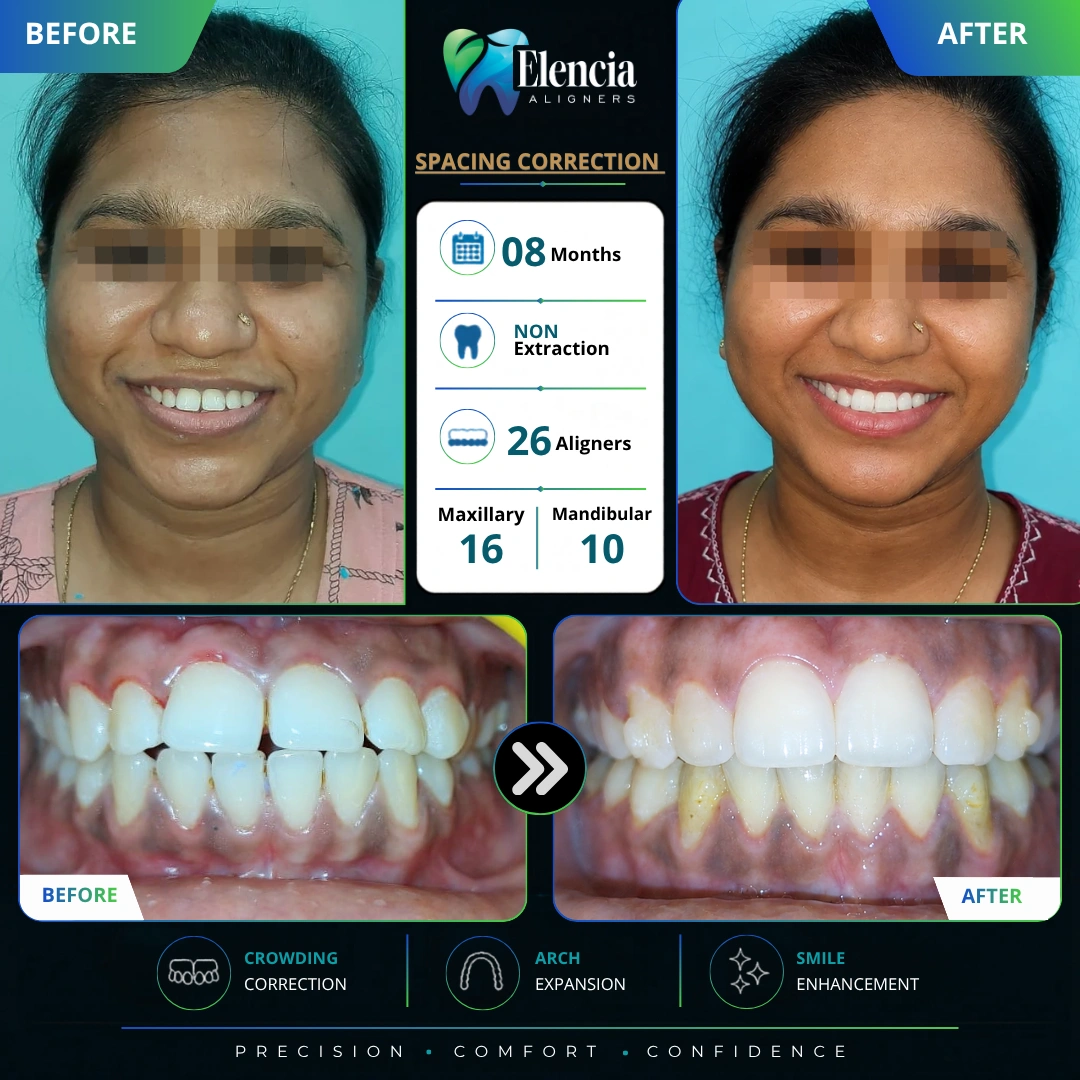 Spacing-Correction-26-aligners