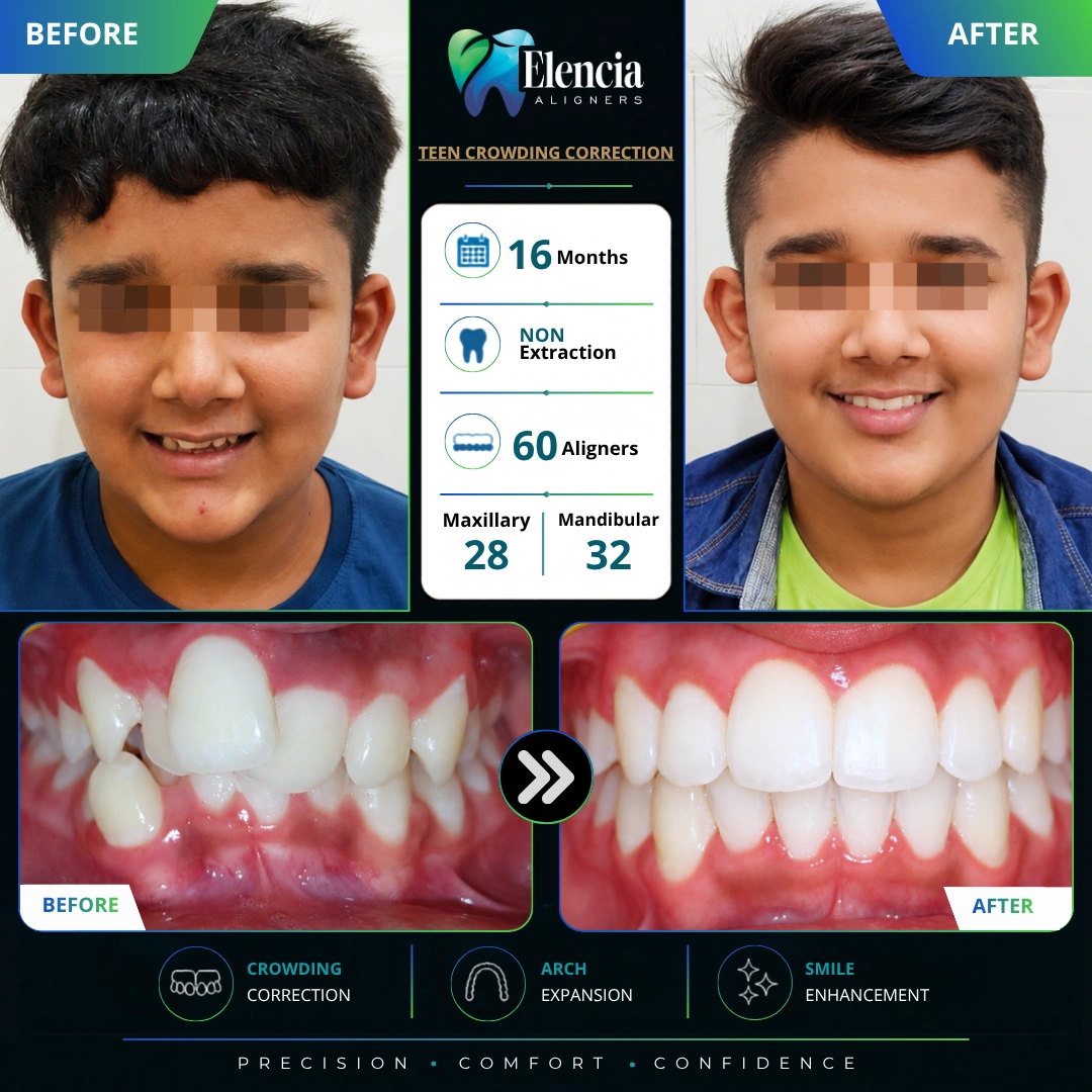 Teen Crowding Correction 16- months- 60-aligners