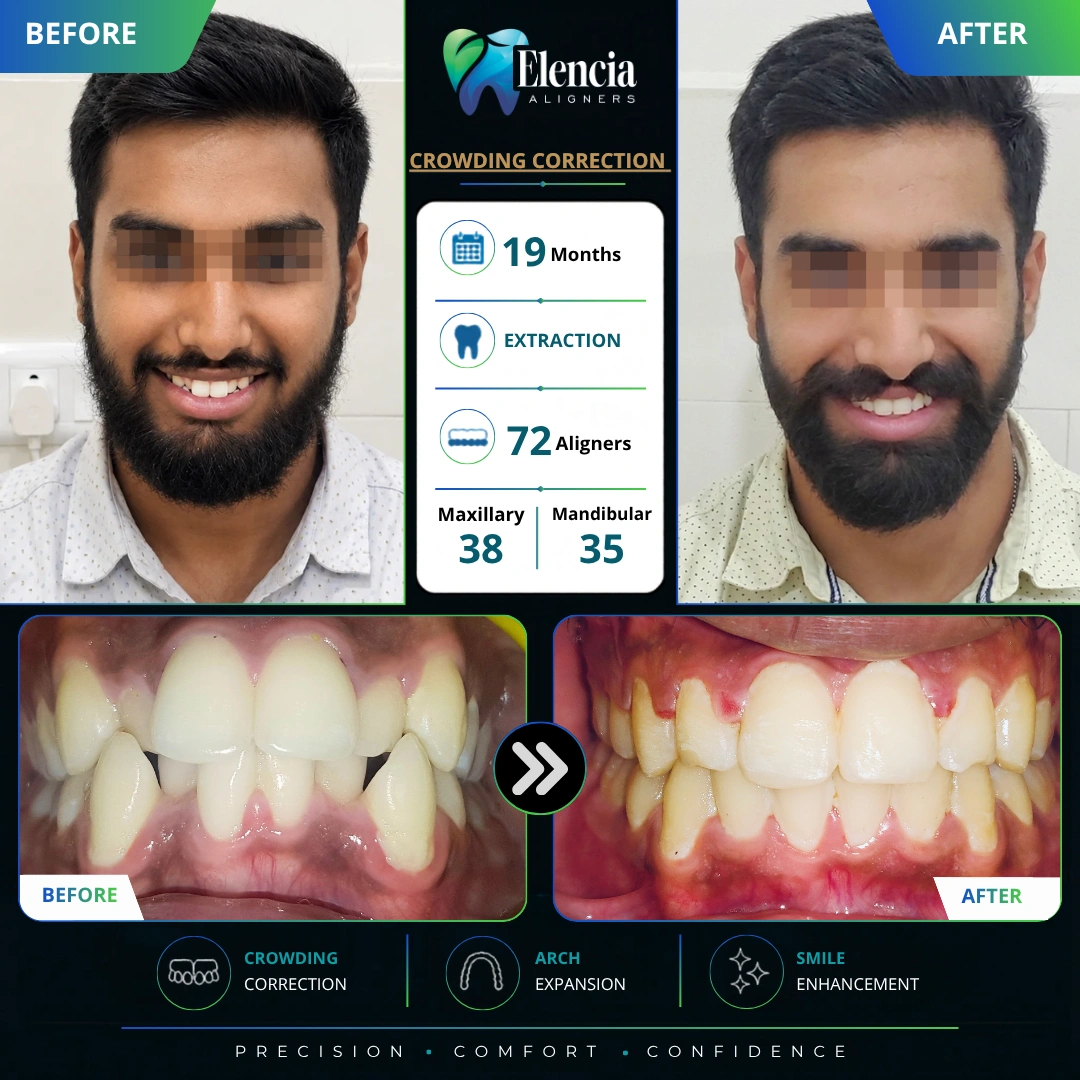 crowding-correction-19-months-72-aligners