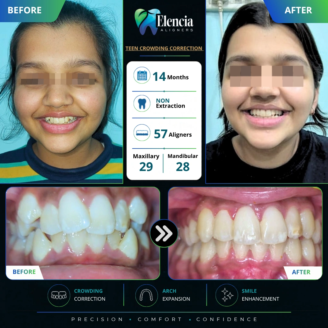 teen-crowding-correction-14-months-57-aligners