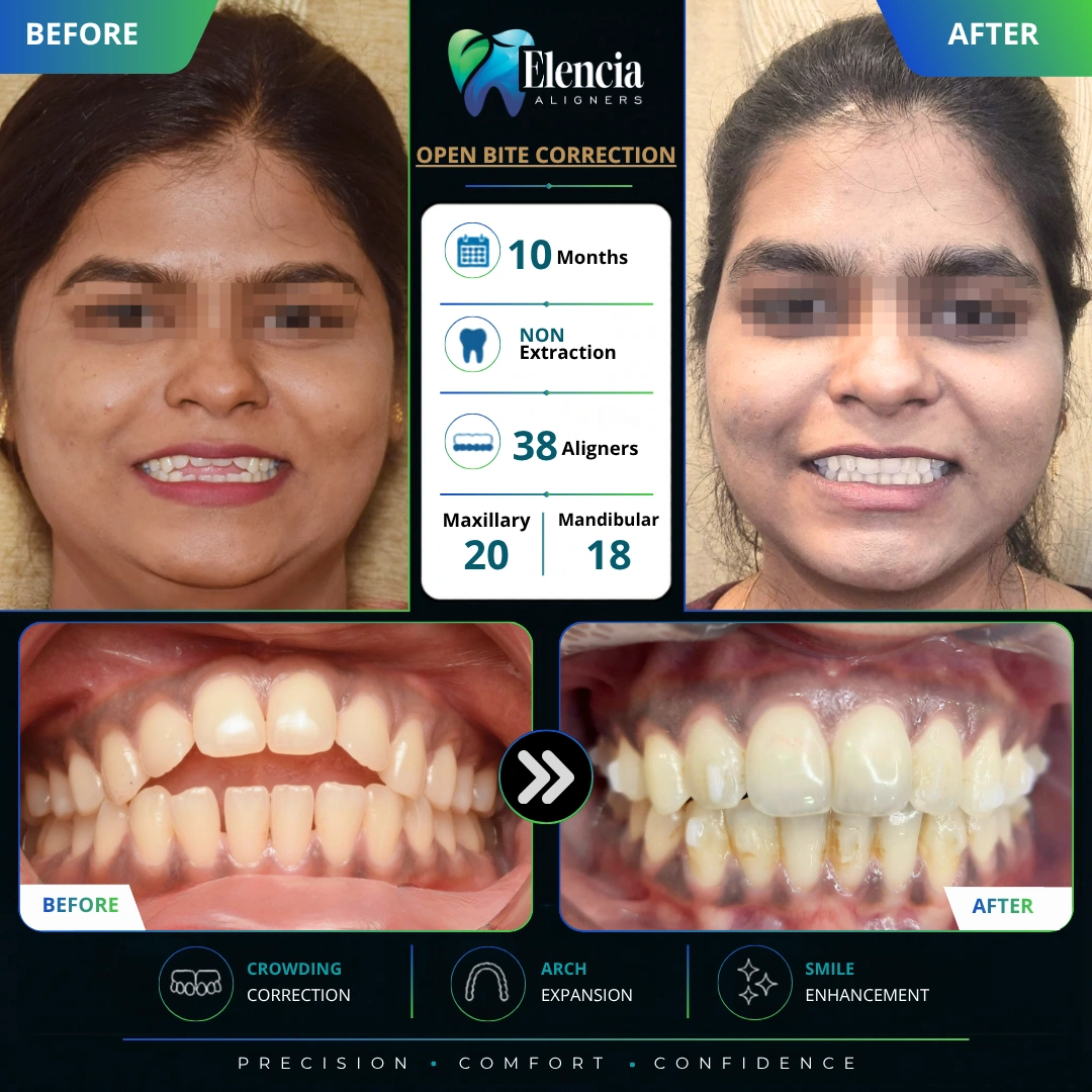 open-bite-correction-10-months-38-aligners