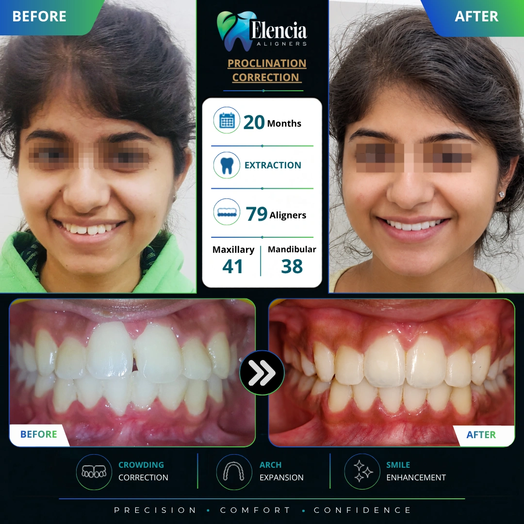 proclination-correction-20-months-79-aligners