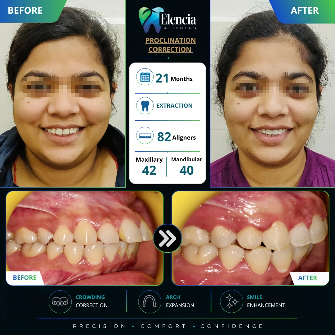 proclination-correction-21-months-82-alingers